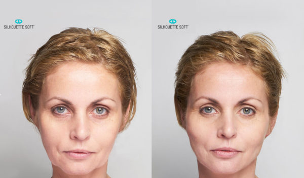 Before-and-After-Silhouette-Soft-Thread-Lifts-002-collagen-stimulating-sutures-Bioscor-Melbourne-Facelift-face-lift-1-600x351
