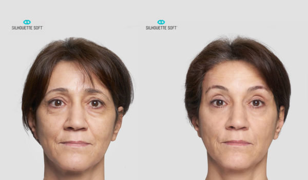 Before-and-After-Silhouette-Soft-Thread-Lifts-004-collagen-stimulating-sutures-Bioscor-Melbourne-Facelift-face-lift-1-600x351
