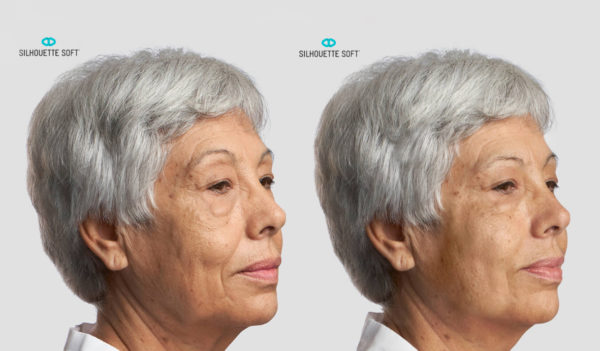 Before-and-After-Silhouette-Soft-Thread-Lifts-005-collagen-stimulating-sutures-Bioscor-Melbourne-Facelift-face-lift-600x351