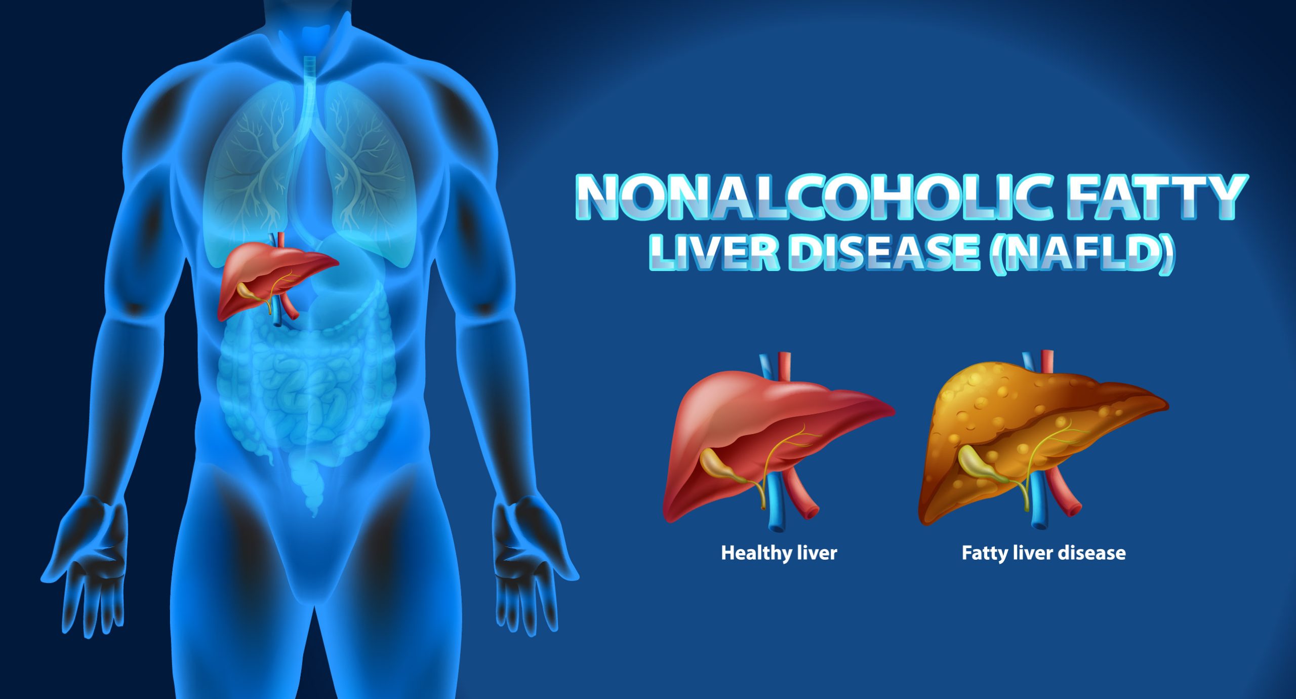 Fatty Liver Disease